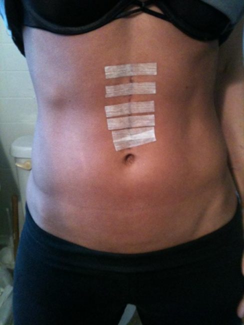 abdomin scar