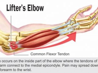 Lifter's elbow