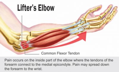 Lifter's elbow