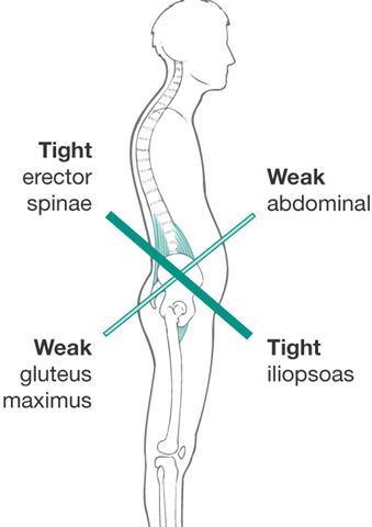 Anterior pelvic tilt causes