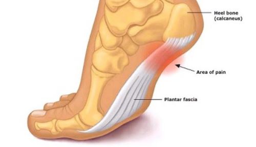 Plantar Fasciitis pain