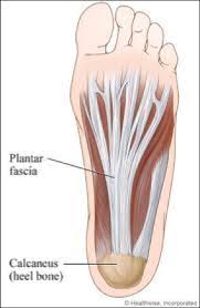 Plantar Fasciitis: Treatment and Prevention